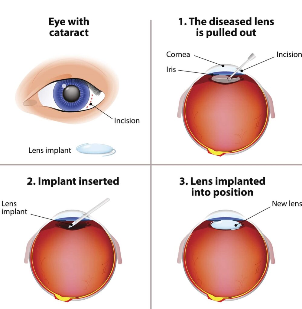 Cataract Surgery Treatment